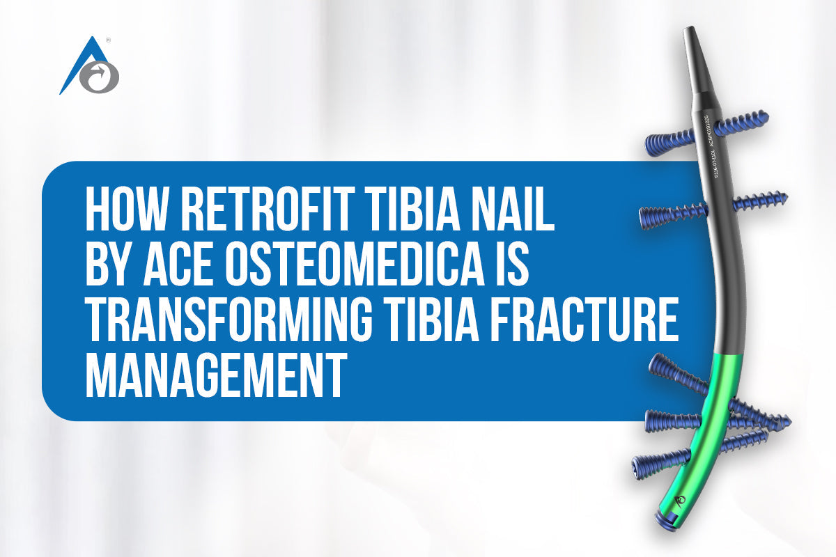 How Retrofit Tibia Nail by Ace Osteomedica is Transforming Tibia Fracture Management