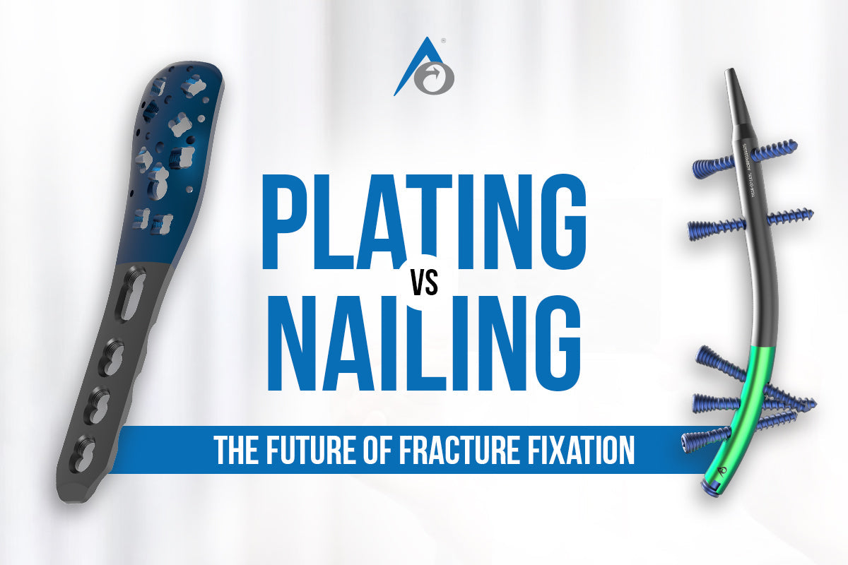Plating vs Nailing: The Future of Fracture Fixation