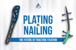 Plating vs Nailing: The Future of Fracture Fixation